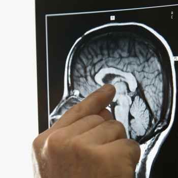 In Memory of Noventri Siahaan The Boy with a Tumour for a Face