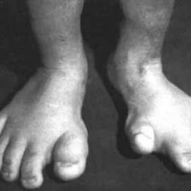 Jordan: The Boy with Proteus Syndrome