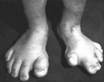 Jordan: The Boy with Proteus Syndrome