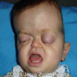 Ellie Reading | Crouzon’s Syndrome | Elena May Reading | David Dunaway