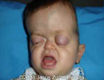 Ellie Reading | Crouzon’s Syndrome | Elena May Reading | David Dunaway