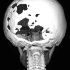 Alex Clementson | Gorham-Stout Syndrome | Vanishing Bone Disease