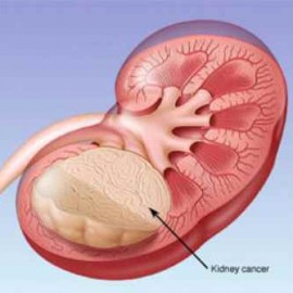 Molly Biederman | Wilms’ Tumour | Dr Gill Levitt