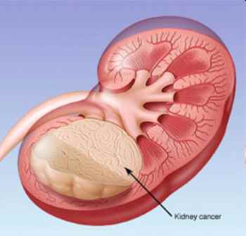 Molly Biederman | Wilms’ Tumour | Dr Gill Levitt