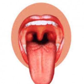 How a cystic hygroma is causing massive swelling of the tongue in young Kody Barrowman. Professor Ben Hartley is his consultant.