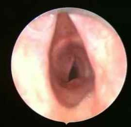 Tahlia Lovegrove | Long Segment Tracheal Stenosis | Professor Martin Elliot