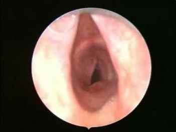 Tahlia Lovegrove | Long Segment Tracheal Stenosis | Professor Martin Elliot