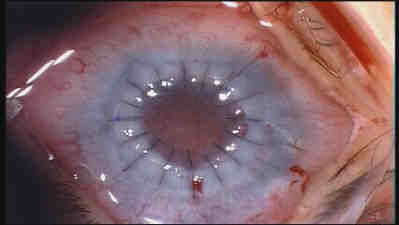 Stitched, Transplanted Cornea