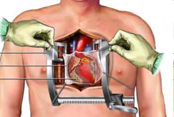 The Heart Surgery in Progress