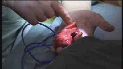 The Tumour Removed from Molly