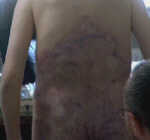 Tumour Removed