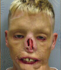 Car Crash Victim