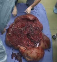 Benign Tumour