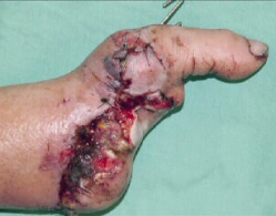 Mangled Thumb