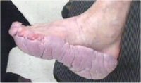 Extra Tissue Growth