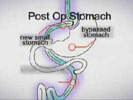 Bypassed Stomach