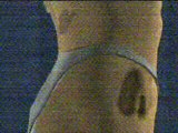 Small Tumours