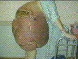 14st tumour