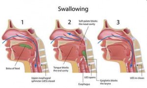 dysphagia