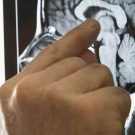 Neurontin or Gabapentin may provide spasm relief in MS