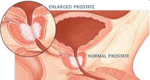 Prostate Gland Pinexel Tamsulosin BPH Benign Prostatic Hyperplasia