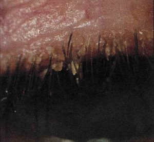 anterior-blpharitis
