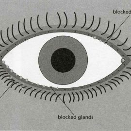 Blepharitis an inflammation of the eyelids