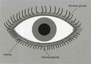 blocked-eye-glands