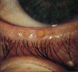 meibomian-blepharitis