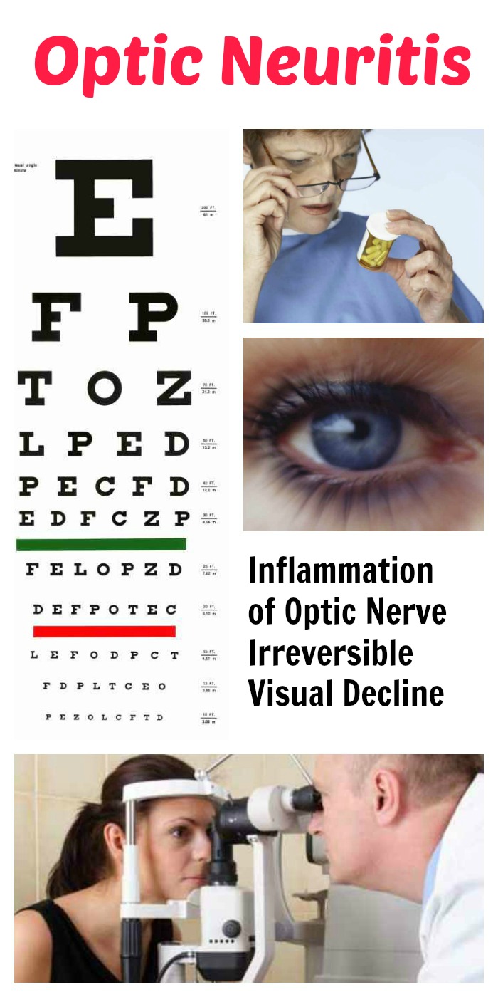 Optic Neuritis MS Multiple Sclerosis Visual Vision Inflammation