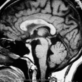 How is brain damage linked to multiple sclerosis lesions?