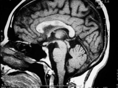 MRI brain scan showing multiple sclerosis lesions brain damage