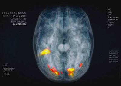 Normal Brain Activity